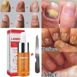 Lanbena Nail Repair Essence For Nail Treatment Anti Fungal Nail Solution - 12ml discountshub
