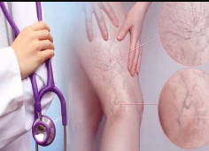 Certificate In Varicose Veins Treatment Alternative Therapy discountshub